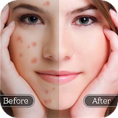 Download Face Blemish Remover (Pro Version MOD) for Android