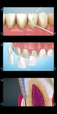Download Dental 3D Illustrations for patient education (Free Ad MOD) for Android