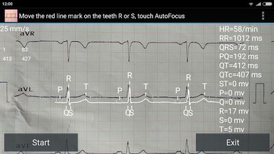 Download ECG Reader free (Free Ad MOD) for Android